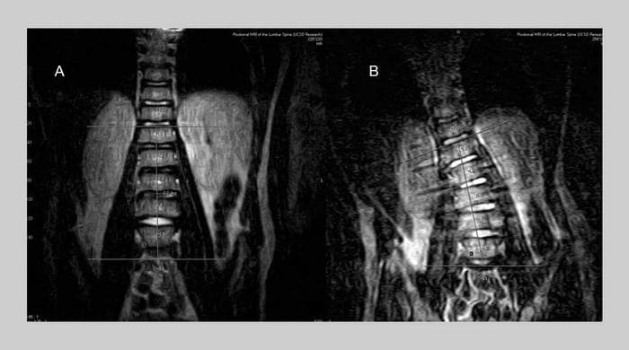 Spine asymmetry in a 9-year-old boy caused by a backpack.